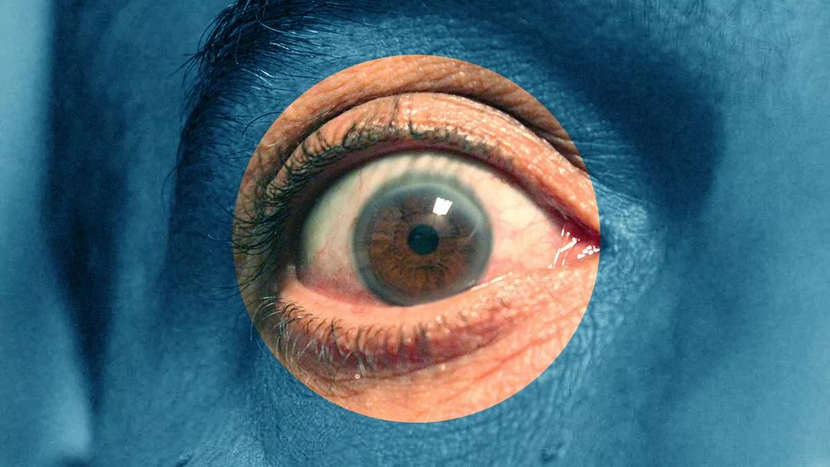 A bloodshot eye surrounded by blue.